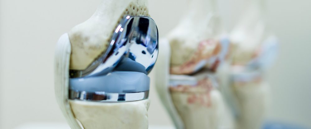 Prótesis de rodilla: Solución para la artrosis que afecta esta articulación